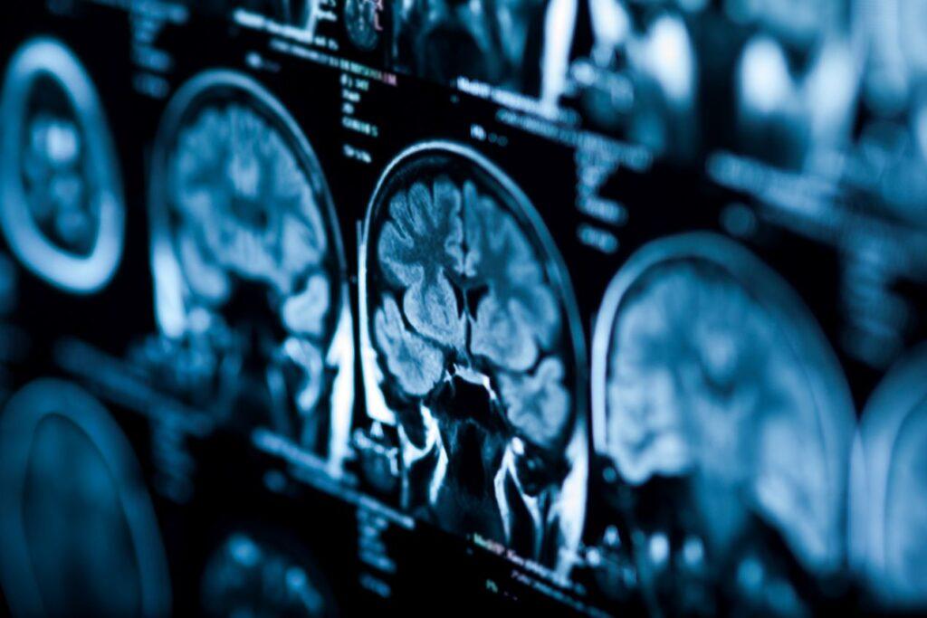 Nahaufnahme eines Hirnscans aus einer neurologischen Untersuchung bei MRT Frankfurt