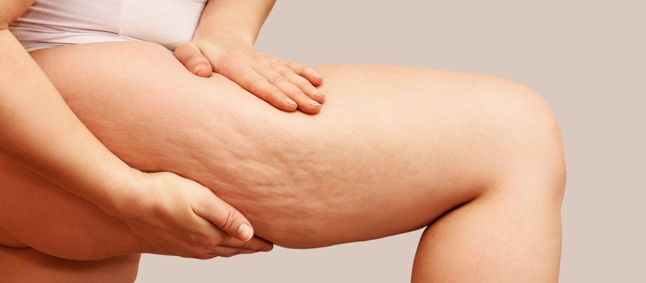 Nahaufnahme eines Oberschenkels mit sichtbarer Cellulite – Beispiel fuer Ausgangssituation vor cellulite behandlung nuernberg